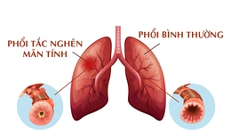 Bệnh phổi tắc nghẽn mạn t&#237;nh: Nguy&#234;n nh&#226;n g&#226;y tử vong xếp h&#224;ng thứ 3