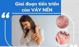 C&#225;c triệu chứng của bệnh vảy nến bạn n&#234;n biết