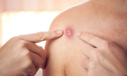 Một ngày phát hiện 4 ca mắc đậu mùa khỉ, TPHCM có nguy cơ bùng phát dịch?