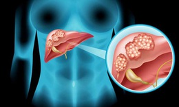 U gan c&#243; phải l&#224; ung thư gan kh&#244;ng?