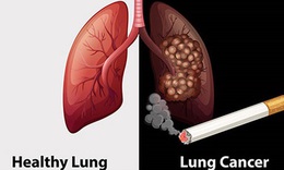 Gần 97% bệnh nhân ung thư phổi có hút thuốc lá