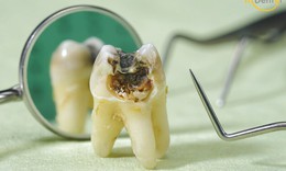 5 vấn đề sức khoẻ răng miệng thường gặp ở người nhiễm HIV