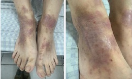 Nhiễm khuẩn, phù nề, tiết dịch vì nghe hàng xóm mách dùng thuốc nam trị viêm da cơ địa