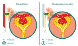 Đường m&#225;u cao ảnh hưởng thế n&#224;o đến thận?