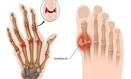 6 c&#225;ch giảm acid uric m&#225;u li&#234;n quan đến bệnh gout