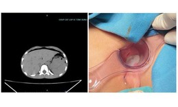 B&#233; 8 tuổi thủng trực tr&#224;ng v&#236; ngồi v&#224;o chiếc b&#250;t do bạn dựng ngược