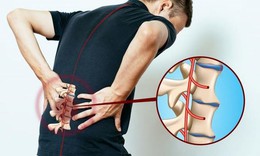 3 lưu ý khi mắc viêm cột sống dính khớp tránh tàn phế