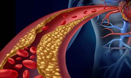 Người bị rối loạn lipid m&#225;u cần lưu &#253; g&#236;?