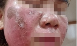 Bỏng nặng trên mặt do điều trị nám da, khuyến cáo từ bác sĩ