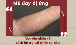 Mề đay dị ứng - Nguy&#234;n nh&#226;n v&#224; c&#225;ch hỗ trợ cải thiện tại nh&#224;