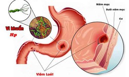 C&#225;ch d&#249;ng thuốc trị vi khuẩn H.Pylori hiệu quả để dự ph&#242;ng vi&#234;m lo&#233;t dạ d&#224;y