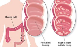 C&#225;c chất dinh dưỡng người vi&#234;m lo&#233;t đại tr&#224;ng hay thiếu hụt v&#224; c&#225;ch bổ sung