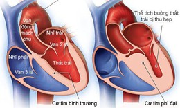 Bệnh cơ tim: Nguy&#234;n nh&#226;n, triệu chứng v&#224; c&#225;ch điều trị