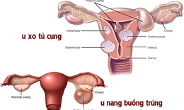 U xơ tử cung, u nang buồng trứng c&#243; nguy hiểm?