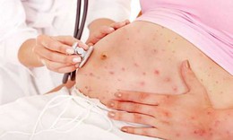 Virus Marburg cực nguy hiểm với phụ nữ mang thai, một số lưu &#253; để kiểm so&#225;t bệnh
