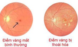 Thuốc mới trị tho&#225;i h&#243;a điểm v&#224;ng do tuổi t&#225;c