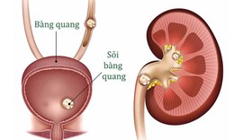 Nhận biết triệu chứng của sỏi b&#224;ng quang v&#224; c&#225;ch điều trị