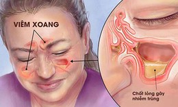 6 biện pháp đơn giản phòng ngừa viêm xoang