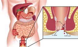 4 b&#224;i tập k&#237;ch th&#237;ch nhu động ruột, hỗ trợ bệnh trĩ kh&#244;ng tăng nặng