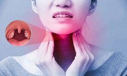 Viêm họng do liên cầu có triệu chứng gì?