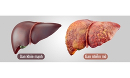 Mới 35 tuổi đ&#227; bị gan nhiễm mỡ độ 3, người đ&#227;n &#244;ng &#39;ng&#227; ngửa&#39; khi biết nguy&#234;n nh&#226;n