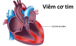 Nguy&#234;n nh&#226;n vi&#234;m cơ tim v&#224; c&#225;c triệu chứng b&#225;o hiệu cần biết