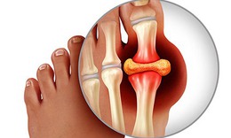 Biểu hiện của bệnh gout v&#224; c&#225;ch chữa hiệu quả