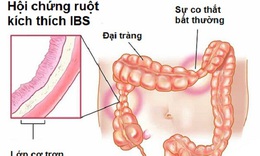 Người mắc hội chứng ruột k&#237;ch th&#237;ch c&#243; n&#234;n bổ sung men vi sinh?