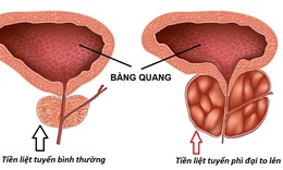 U ph&#236; đại tiền liệt tuyến: Nguy&#234;n nh&#226;n, hậu quả v&#224; phương hướng điều trị