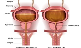 Tiểu kh&#243;, tiểu đ&#234;m nhiều do ph&#236; đại tuyến tiền liệt, phải l&#224;m sao?