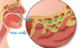 6 biện ph&#225;p tự nhi&#234;n điều trị nghẹt mũi