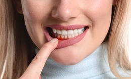M&#225;t xa đường viền nướu ngăn ngừa tụt lợi, loại bỏ cao răng