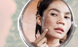 B&#237; quyết hỗ trợ ph&#225;i đẹp ‘tho&#225;t’ khỏi n&#225;m l&#226;u năm