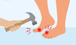 V&#236; sao bệnh gout g&#226;y đau v&#224; d&#249;ng thuốc g&#236; để giảm đau?