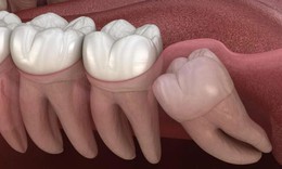Răng mọc ngầm: Nguy&#234;n nh&#226;n, biểu hiện v&#224; điều trị