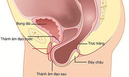 Sa trực tr&#224;ng dễ nhầm với bệnh g&#236;? Ai hay bị sa trực tr&#224;ng?