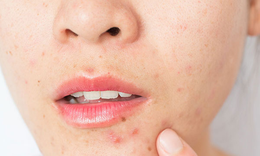 Nguyên nhân gây mụn dưới cằm và cách khắc phục