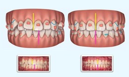 Niềng răng trong suốt: Yếu tố nào quyết định?