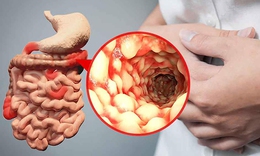 6 c&#225;ch ngăn chặn sự b&#249;ng ph&#225;t của bệnh Crohn