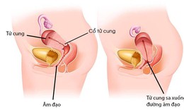 3 c&#225;ch phục hồi sa tử cung tại nh&#224;, &#225;p dụng ngay