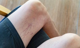 Suy giãn tĩnh mạch chi dưới dễ chẩn đoán nhầm với bệnh nào?