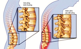 Vi&#234;m cột sống d&#237;nh khớp, điều trị như thế n&#224;o?