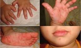 6.000 chai thuốc Immunoglobulin cung ứng cho các bệnh viện để điều trị bệnh nhân mắc tay chân miệng
