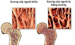 4 loại thực phẩm c&#243; thể g&#226;y lo&#227;ng xương