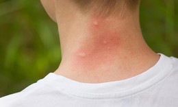 Mùa hè cảnh giác với sẩn ngứa do côn trùng
