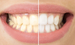C&#225;ch duy tr&#236; răng hiệu quả sau khi tẩy trắng