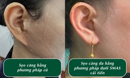 Chuy&#234;n gia chia sẻ về kỹ thuật căng da phẫu thuật dưới SMAS