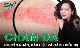 Ch&#224;m da: C&#225;ch điều trị thế n&#224;o? C&#243; chữa khỏi được kh&#244;ng?