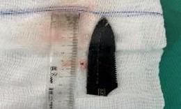 Lưỡi dao 10cm nằm trong bả vai nam thanh ni&#234;n 