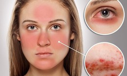 Biểu hiện của bệnh lupus ban đỏ hệ thống v&#224; c&#225;ch điều trị